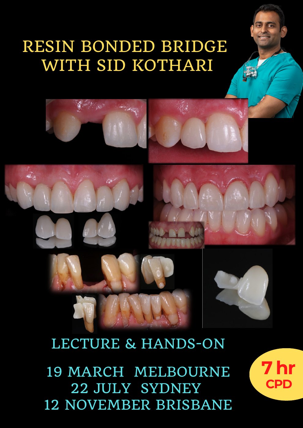 First page of the Resin Bonded Bridge course poster