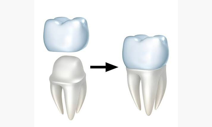 Ceramic dental crown suspended above a tooth